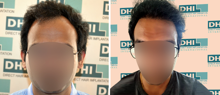 DHI before & after hair transplant results